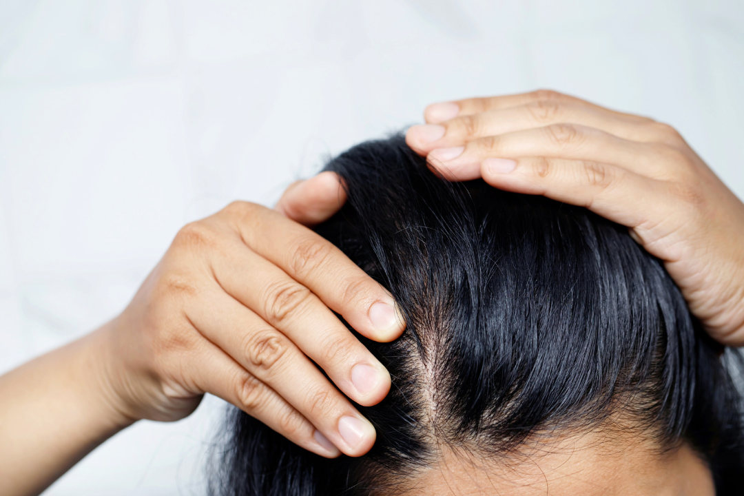 Dandruff Dry Scalp or Product Build Up